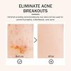 Tobcharm Butt Acne Clearing Treatment, Back Acne Treatment, Body Acne Treatment with Azelaic Acid 3.4 fl. oz., Great for Men and Women Acne Scar Treatment, Even For Hormonal Acne And Cystic Acne Treatment